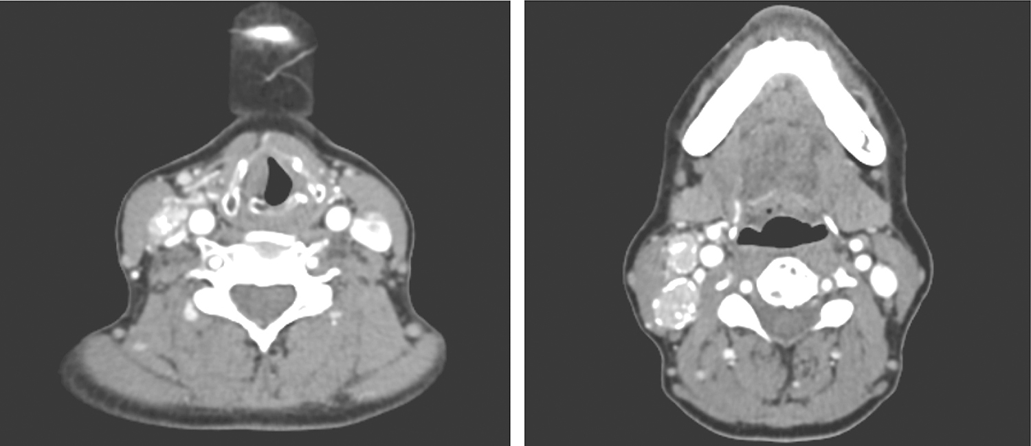 /uploads/image/2025-05-26/160722441图4 颈部增强CT示右颈多发结节状稍高密度影伴钙化.jpg 图4 颈部增强CT示右颈多发结节状稍高密度影伴钙化